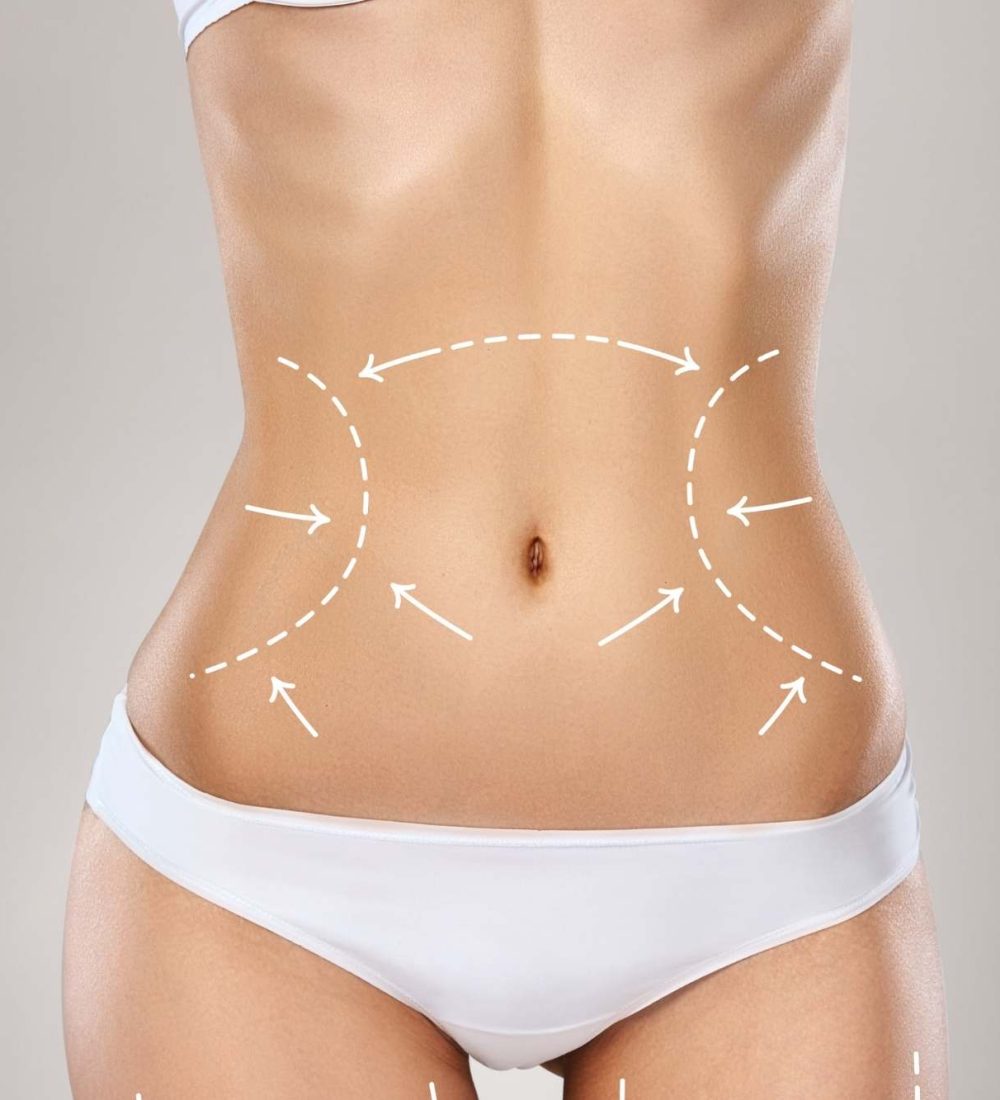 Abdominoplastia
