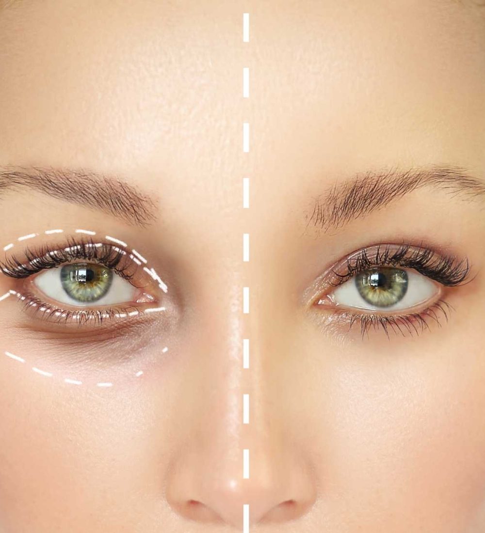 Blefaroplastia